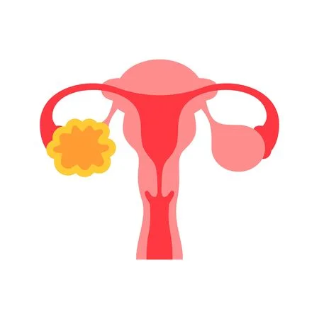 Vector Image of PCOD / PCOS